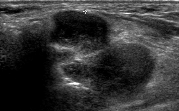 Figure 3 for case Plexiform schwannoma ( RID4480 )